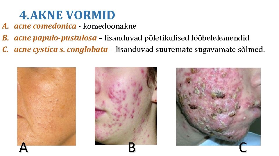 4. AKNE VORMID A. acne comedonica - komedoonakne B. acne papulo-pustulosa – lisanduvad põletikulised