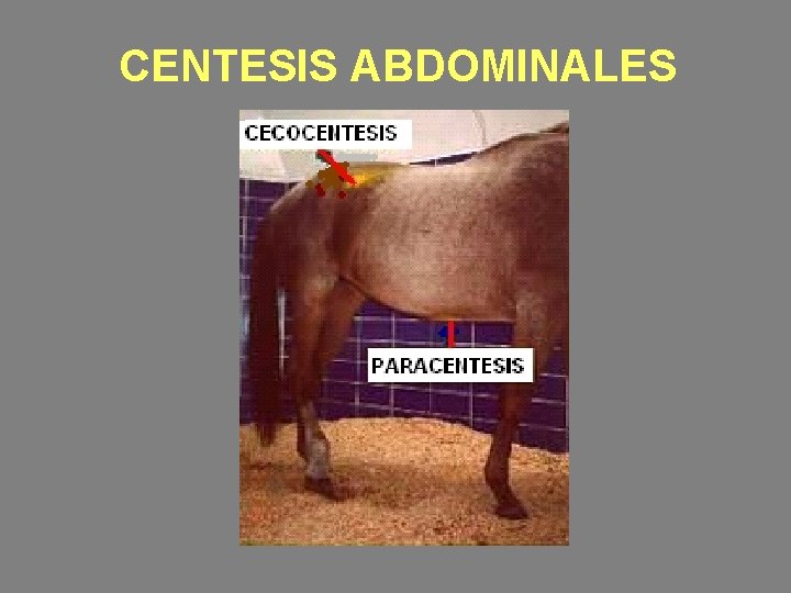 CENTESIS ABDOMINALES 