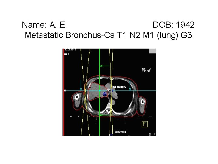 Name: A. E. DOB: 1942 Metastatic Bronchus-Ca T 1 N 2 M 1 (lung)