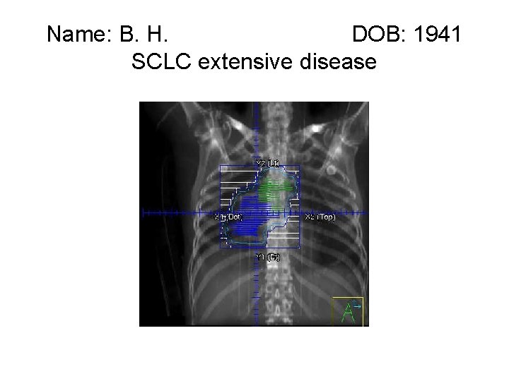 Name: B. H. DOB: 1941 SCLC extensive disease 