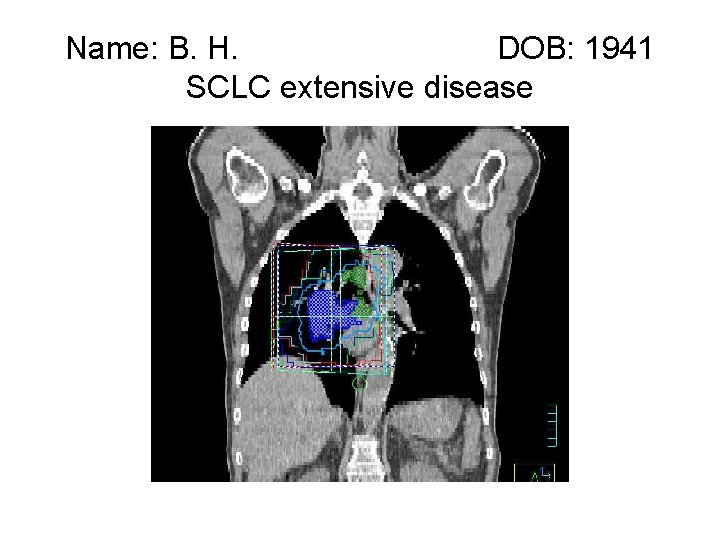 Name: B. H. DOB: 1941 SCLC extensive disease 