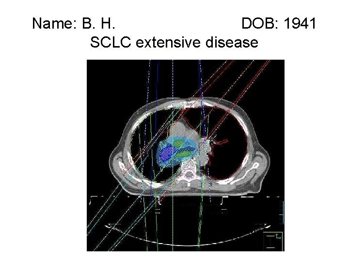 Name: B. H. DOB: 1941 SCLC extensive disease 