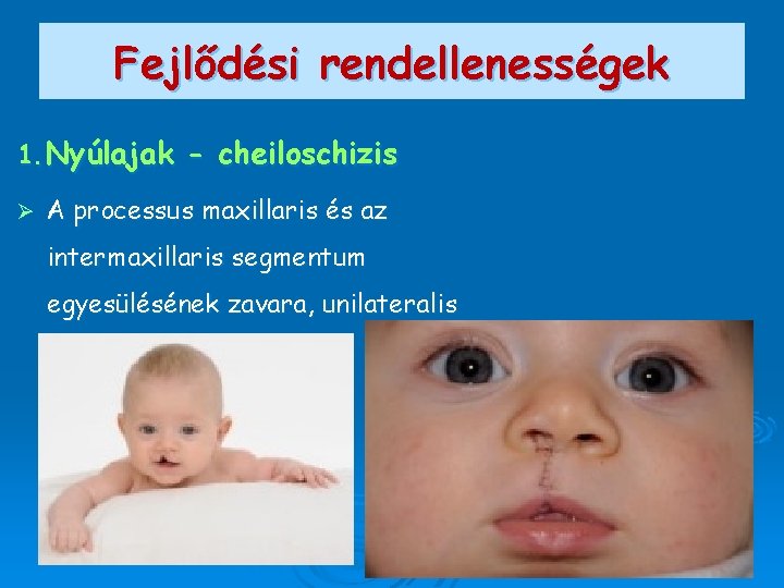 Fejlődési rendellenességek 1. Nyúlajak - cheiloschizis Ø A processus maxillaris és az intermaxillaris segmentum