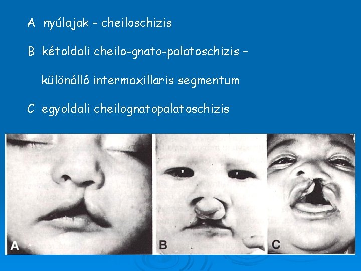 A nyúlajak – cheiloschizis B kétoldali cheilo-gnato-palatoschizis – különálló intermaxillaris segmentum C egyoldali cheilognatopalatoschizis