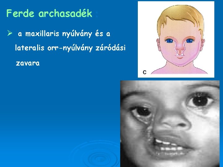 Ferde archasadék : Ø a maxillaris nyúlvány és a lateralis orr-nyúlvány záródási zavara 