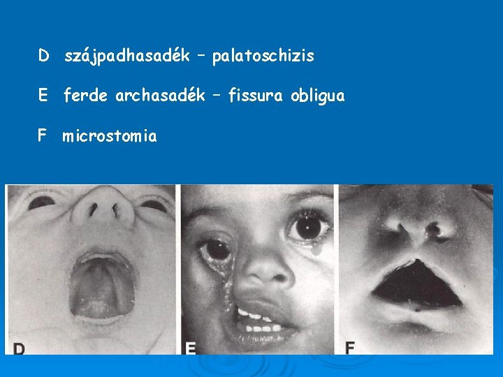 D szájpadhasadék – palatoschizis E ferde archasadék – fissura obligua F microstomia 