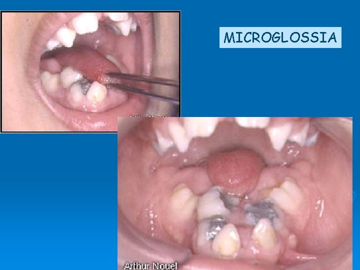 MICROGLOSSIA 