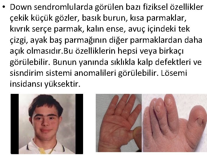  • Down sendromlularda görülen bazı fiziksel özellikler çekik küçük gözler, basık burun, kısa