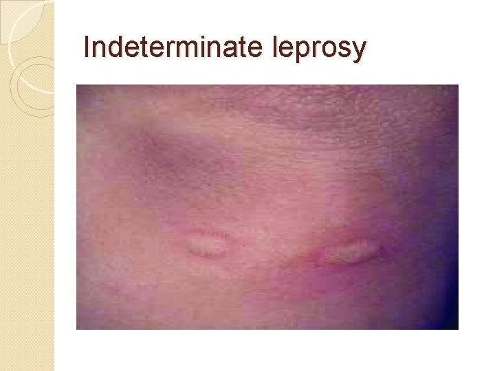 Indeterminate leprosy 