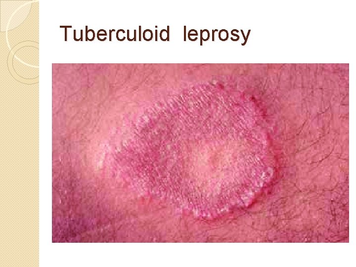 Tuberculoid leprosy 