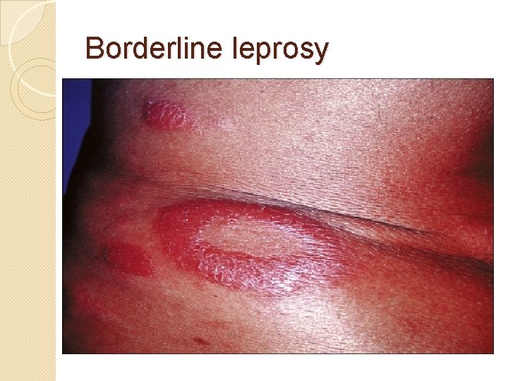 Borderline leprosy 