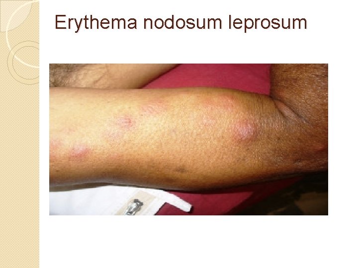 Erythema nodosum leprosum 