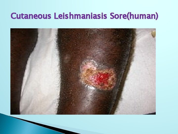 Cutaneous Leishmaniasis Sore(human) 