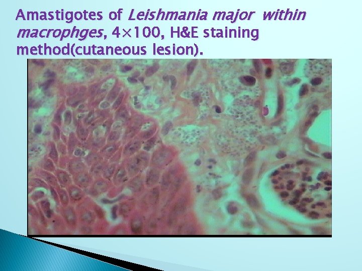 Amastigotes of Leishmania major within macrophges, 4× 100, H&E staining method(cutaneous lesion). 