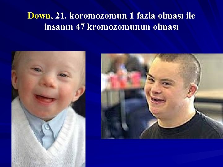 Down, 21. koromozomun 1 fazla olması ile insanın 47 kromozomunun olması 
