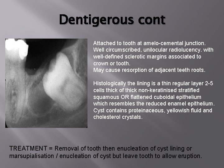 Dentigerous cont Attached to tooth at amelo-cemental junction. Well circumscribed, unilocular radiolucency. with well-defined Dentigerous cont Attached to tooth at amelo-cemental junction. Well circumscribed, unilocular radiolucency. with well-defined