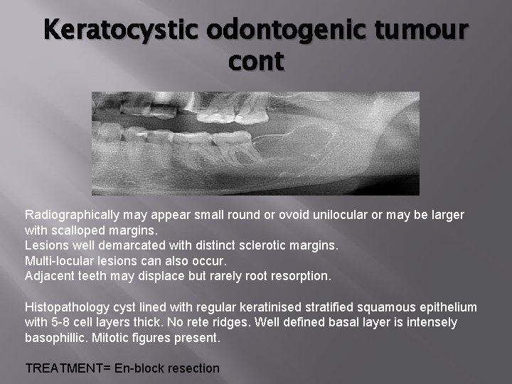 Keratocystic odontogenic tumour cont Radiographically may appear small round or ovoid unilocular or may