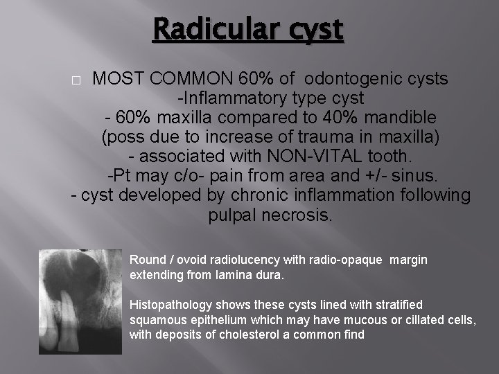 Radicular cyst MOST COMMON 60% of odontogenic cysts -Inflammatory type cyst - 60% maxilla