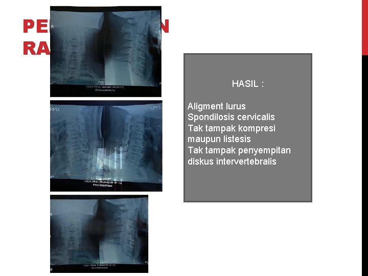 PEMERIKSAAN RADIOLOGI HASIL : Aligment lurus Spondilosis cervicalis Tak tampak kompresi maupun listesis Tak