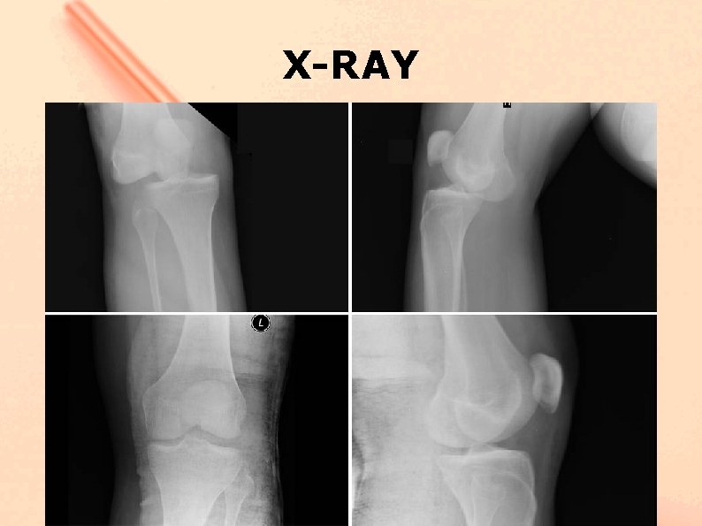 X-RAY 