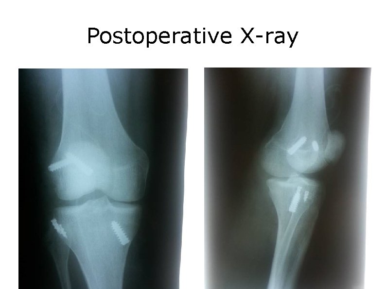 Postoperative X-ray 