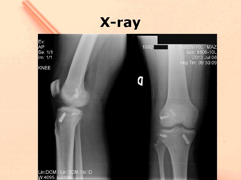 X-ray 