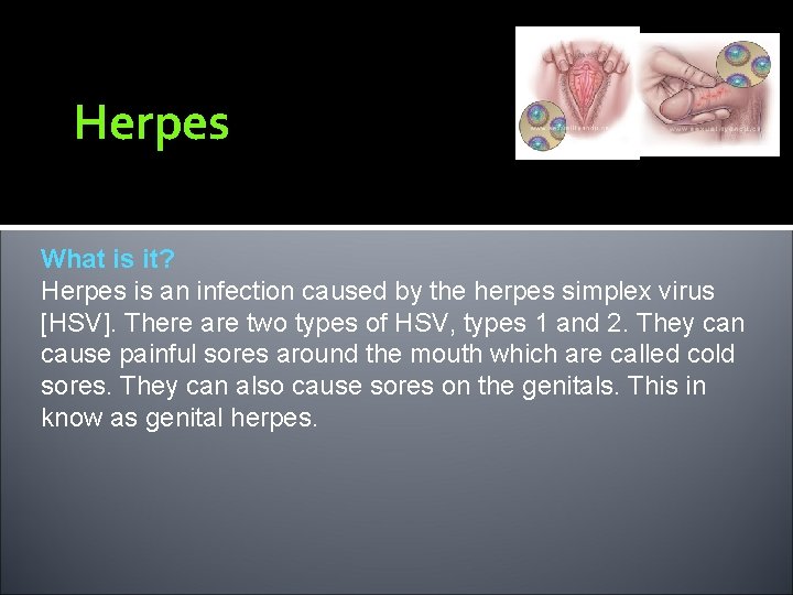 Herpes What is it? Herpes is an infection caused by the herpes simplex virus