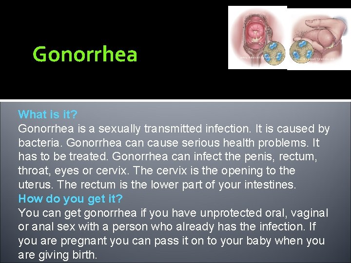 Gonorrhea What is it? Gonorrhea is a sexually transmitted infection. It is caused by