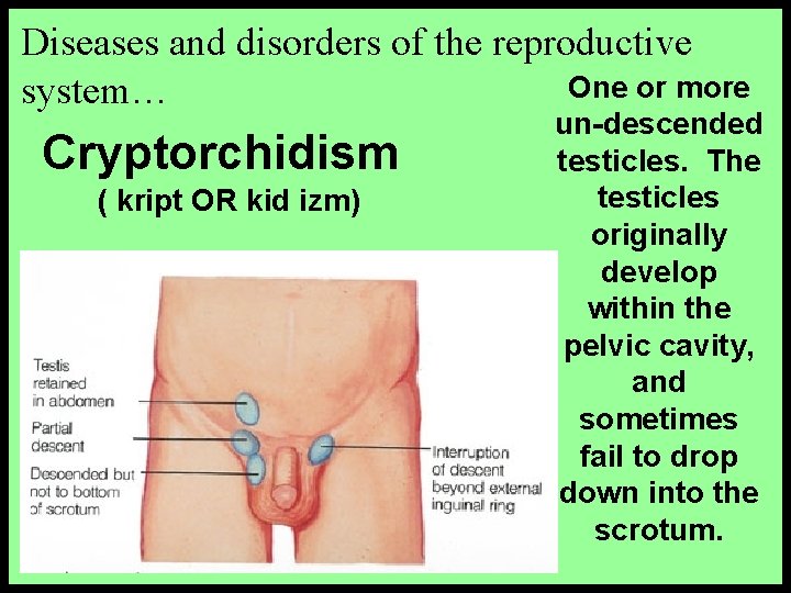 Diseases and disorders of the reproductive One or more system… Cryptorchidism ( kript OR