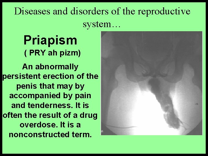 Diseases and disorders of the reproductive system… Priapism ( PRY ah pizm) An abnormally