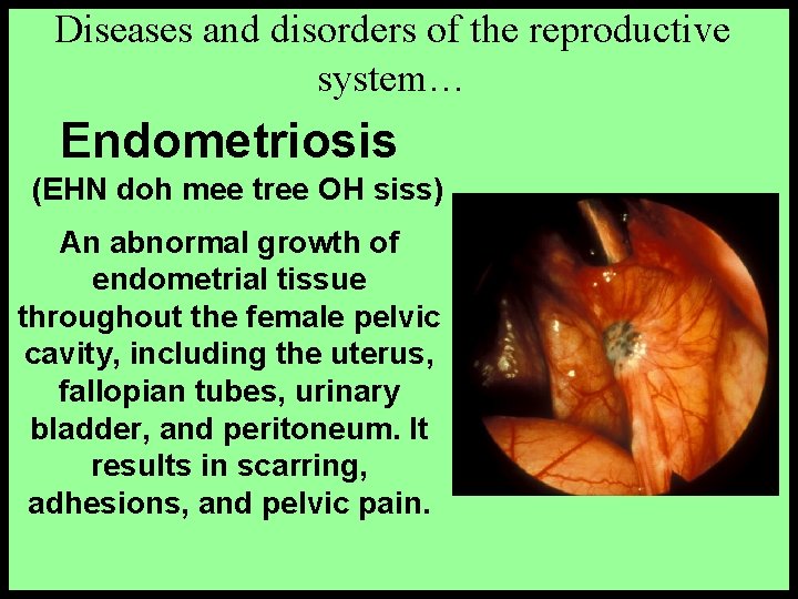 Diseases and disorders of the reproductive system… Endometriosis (EHN doh mee tree OH siss)