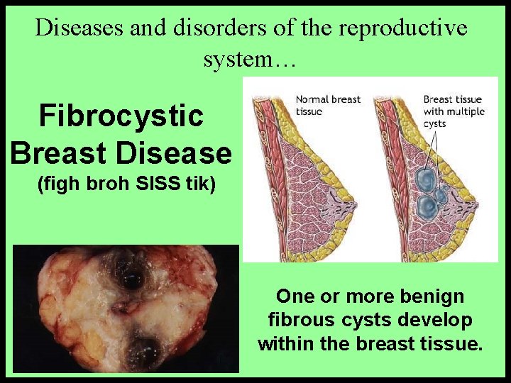 Diseases and disorders of the reproductive system… Fibrocystic Breast Disease (figh broh SISS tik)
