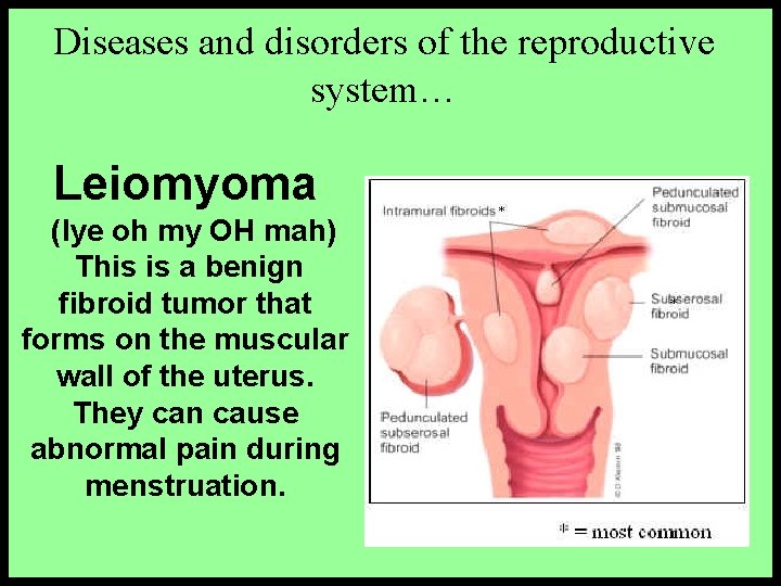 Diseases and disorders of the reproductive system… Leiomyoma (lye oh my OH mah) This