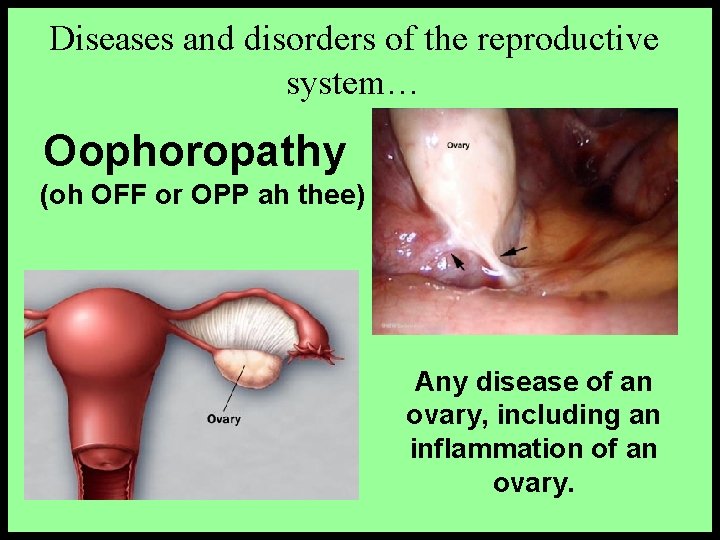 Diseases and disorders of the reproductive system… Oophoropathy (oh OFF or OPP ah thee)