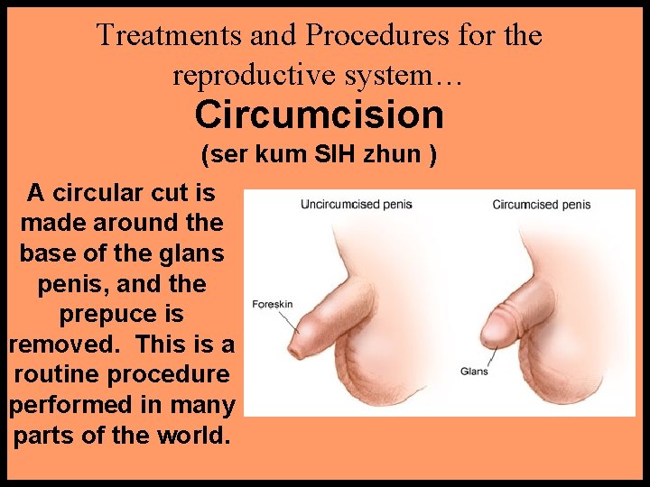 Treatments and Procedures for the reproductive system… Circumcision (ser kum SIH zhun ) A