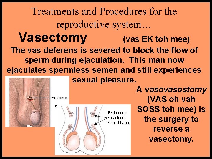 Treatments and Procedures for the reproductive system… Vasectomy (vas EK toh mee) The vas