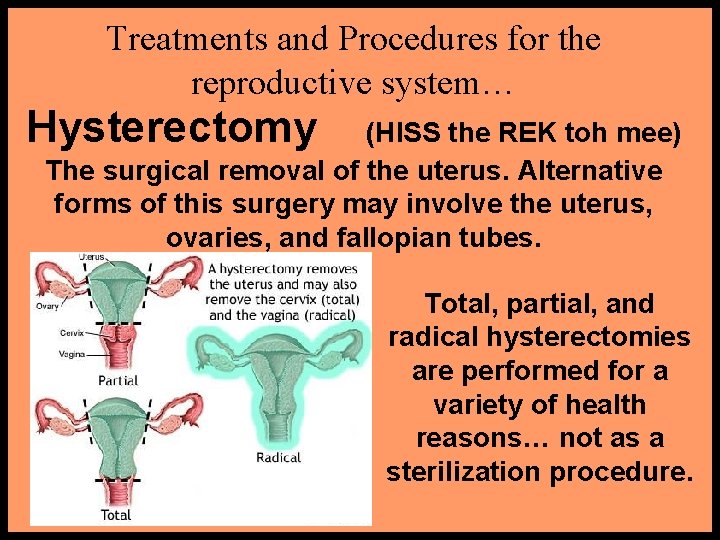 Treatments and Procedures for the reproductive system… Hysterectomy (HISS the REK toh mee) The