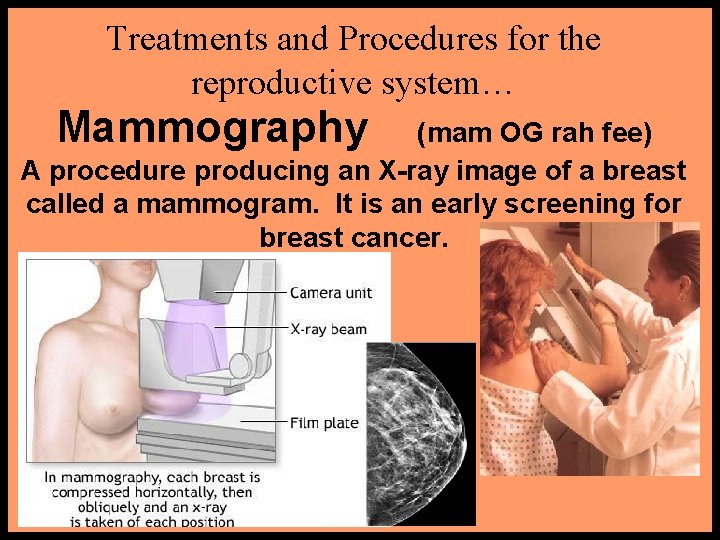 Treatments and Procedures for the reproductive system… Mammography (mam OG rah fee) A procedure