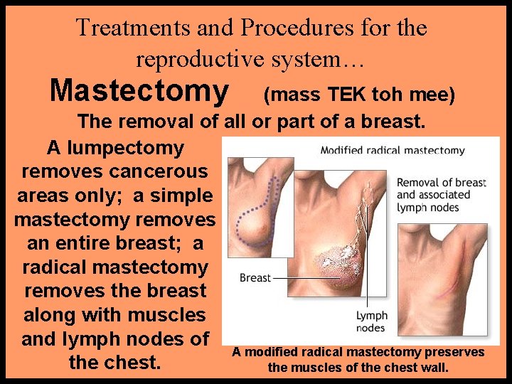 Treatments and Procedures for the reproductive system… Mastectomy (mass TEK toh mee) The removal