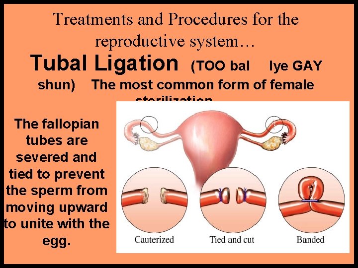 Treatments and Procedures for the reproductive system… Tubal Ligation shun) (TOO bal lye GAY