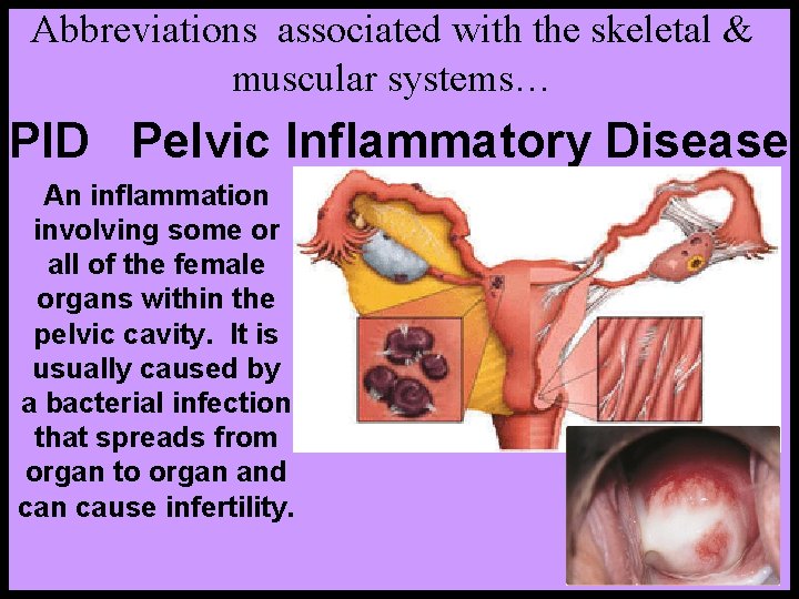 Abbreviations associated with the skeletal & muscular systems… PID Pelvic Inflammatory Disease An inflammation