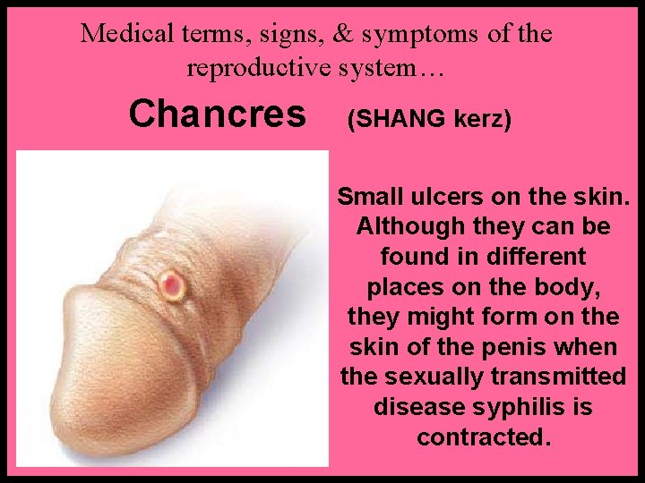 Medical terms, signs, & symptoms of the reproductive system… Chancres (SHANG kerz) Small ulcers