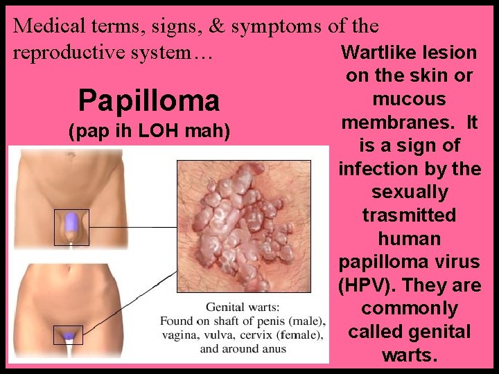 Medical terms, signs, & symptoms of the Wartlike lesion reproductive system… Papilloma (pap ih