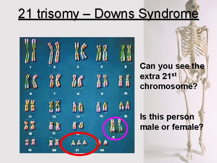 21 trisomy – Downs Syndrome Can you see the extra 21 st chromosome? Is