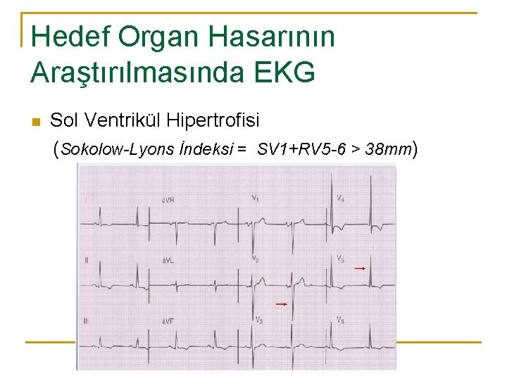Hedef Organ Hasarının Araştırılmasında EKG n Sol Ventrikül Hipertrofisi (Sokolow-Lyons İndeksi = SV 1+RV