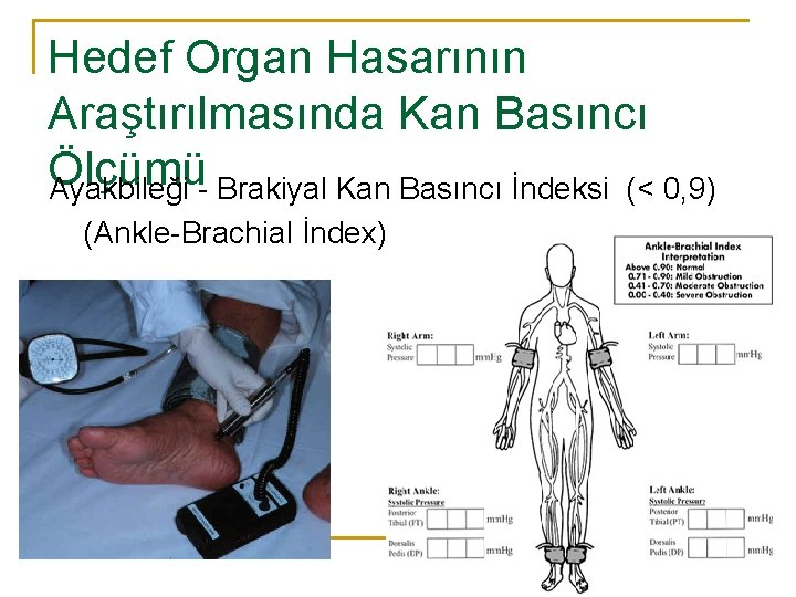 Hedef Organ Hasarının Araştırılmasında Kan Basıncı Ölçümü Ayakbileği - Brakiyal Kan Basıncı İndeksi (<