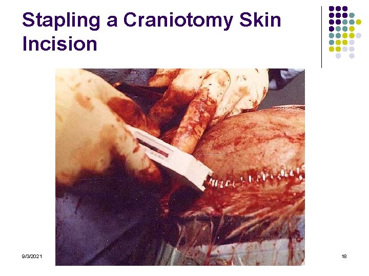 Stapling a Craniotomy Skin Incision 9/3/2021 18 