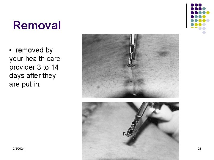 Removal • removed by your health care provider 3 to 14 days after they