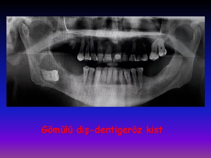 Gömülü diş-dentigeröz kist 