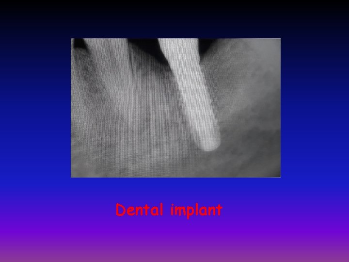 Dental implant 